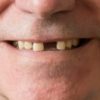 Consequências-da-perda-de-um-dente-300x132